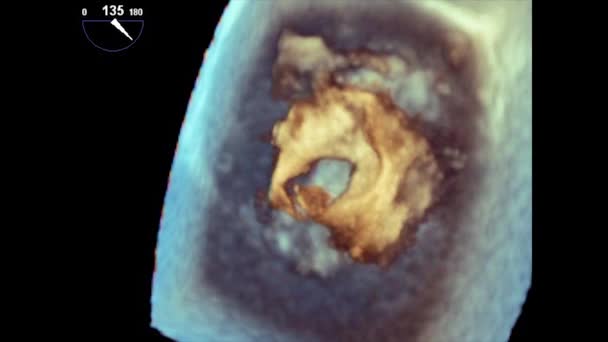 心脏经食管超声影像 食管超声心动图 — 图库视频影像