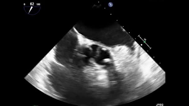 Video Transesophageal Ultrasound Heart Transesophageal Ultrasound Echocardiography — ストック動画