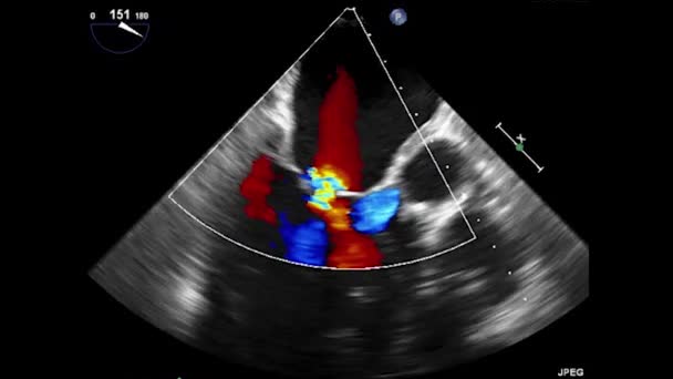 Video Transesophageal Ultrasound Hati Ultrasound Transesophageal Echocardiography — Stok Video