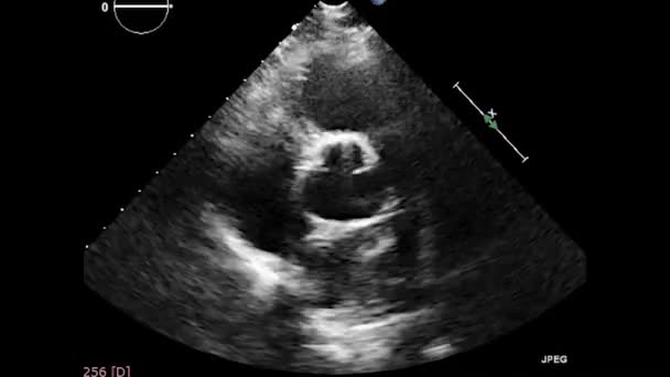 Video Transesophageal Ultrasound Heart Transesophageal Ultrasound Echocardiography — ストック動画