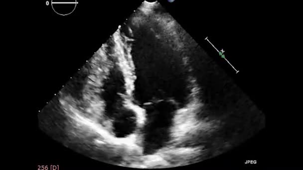 Ultrasonido Transesofágico Video Del Corazón Ecocardiografía Por Ultrasonido Transesofágico — Vídeo de stock