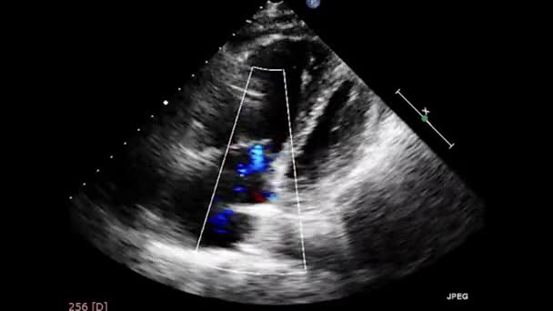 Ecografia Video Transesofagea Del Cuore Ecografia Transesofagea Ecocardiografia — Video Stock