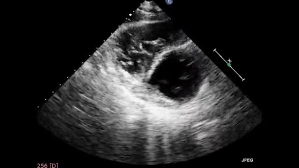 Vídeo Ultra Som Transesofágico Coração Ecocardiografia Por Ultrassom Transesofágico — Vídeo de Stock