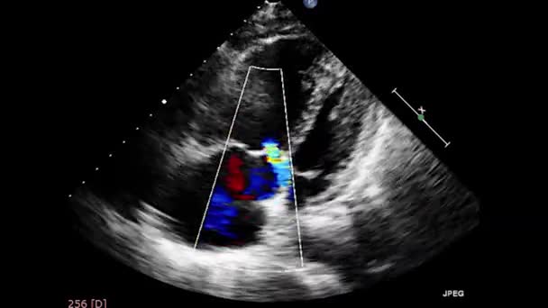 Video Transesofageale Echografie Van Het Hart Transslokdarmultrasone Echografie Echocardiografie — Stockvideo