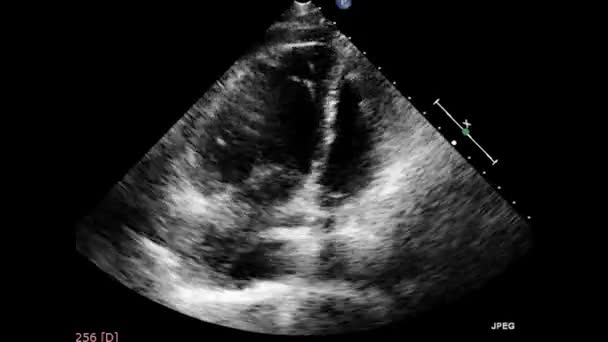 Vídeo Ultra Som Transesofágico Coração Ecocardiografia Por Ultrassom Transesofágico — Vídeo de Stock