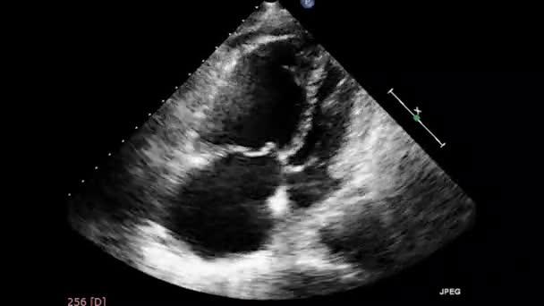 Vídeo Ultra Som Transesofágico Coração Ecocardiografia Por Ultrassom Transesofágico — Vídeo de Stock