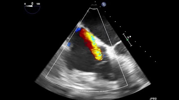 Ecografia Video Transesofagea Del Cuore Ecografia Transesofagea Ecocardiografia — Video Stock