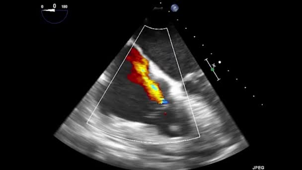 Ultrasonido Transesofágico Video Del Corazón Ecocardiografía Por Ultrasonido Transesofágico — Vídeo de stock