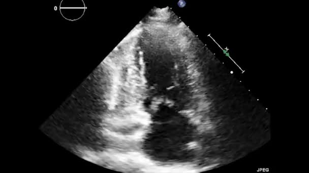 Ultrasonido Transesofágico Video Del Corazón Ecocardiografía Por Ultrasonido Transesofágico — Vídeos de Stock