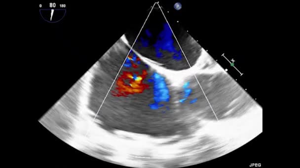 Ultrasonido Transesofágico Video Del Corazón Ecocardiografía Por Ultrasonido Transesofágico — Vídeo de stock