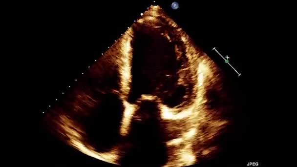 Video Transesophageal Ultrasound Heart Transesophageal Ultrasound Echocardiography — Stock Video