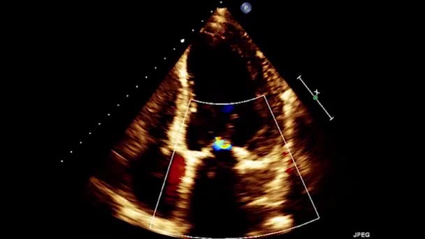 Vídeo Ultra Som Transesofágico Coração Ecocardiografia Por Ultrassom Transesofágico — Vídeo de Stock