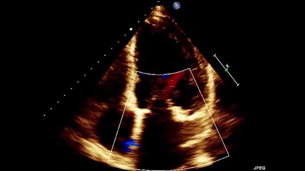 Ultrasonido Transesofágico Video Del Corazón Ecocardiografía Por Ultrasonido Transesofágico — Vídeos de Stock