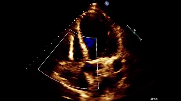 Kalbin Transsofageal Ultrasonu Transesophageal Ultrason Ekokardiyografisi — Stok video
