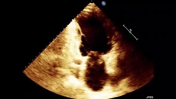 Video Transesofageal Ultraljud Hjärtat Transesofageal Ultraljud Ekokardiografi — Stockvideo