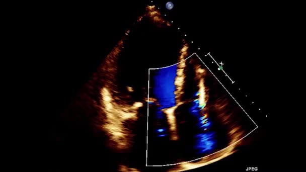 Βίντεο Υπερηχογράφημα Του Οισοφάγου Της Καρδιάς Υπερηχοκαρδιογραφία Του Οισοφάγου — Αρχείο Βίντεο