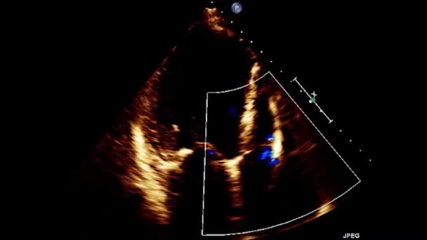 Kalbin Transsofageal Ultrasonu Transesophageal Ultrason Ekokardiyografisi — Stok video