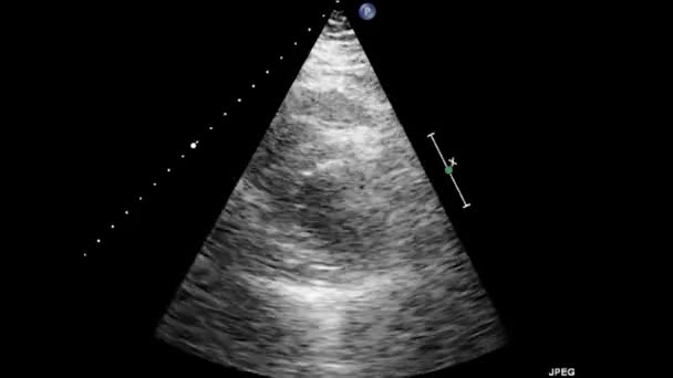 Wideo Przełykowe Usg Serca Usg Przełyku Echokardiografia — Wideo stockowe
