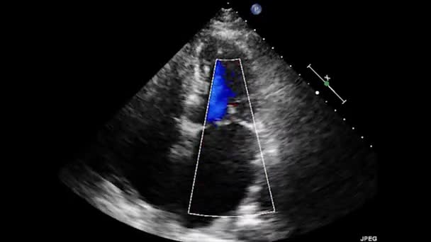 Video Transesophageální Ultrazvuk Srdce Transesofageální Ultrazvuková Echokardiografie — Stock video