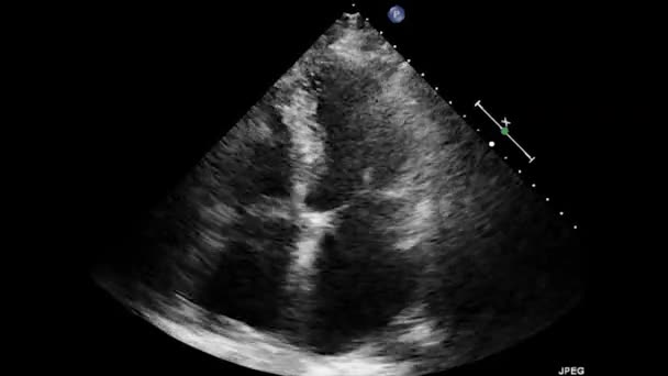 Ultrasonido Transesofágico Video Del Corazón Ecocardiografía Por Ultrasonido Transesofágico — Vídeos de Stock