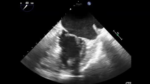 Videó Transznyelőcső Ultrahang Szív Transesophagealis Ultrahang Echokardiográfia — Stock videók