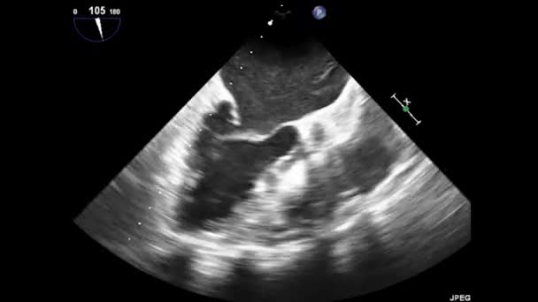 Video Transesophageal Ultrasound Hati Ultrasound Transesophageal Echocardiography — Stok Video