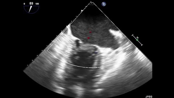 Video Transesophageal Ultrasound Heart Transesophageal Ultrasound Echocardiography — ストック動画