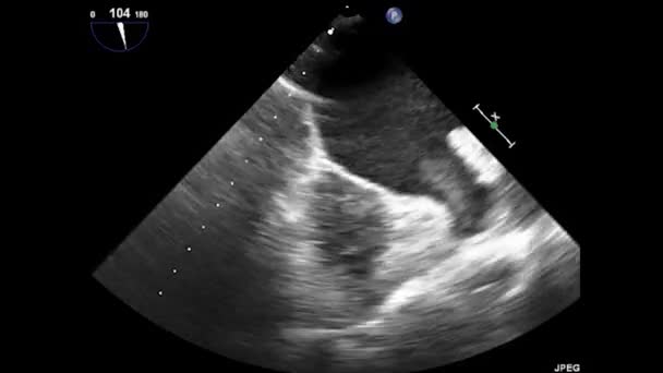 Videó Transznyelőcső Ultrahang Szív Transesophagealis Ultrahang Echokardiográfia — Stock videók