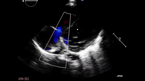 ลตร าซาวด ของห วใจ เคร องอ ลตราซาวด Transesophageal Echocardiography — วีดีโอสต็อก