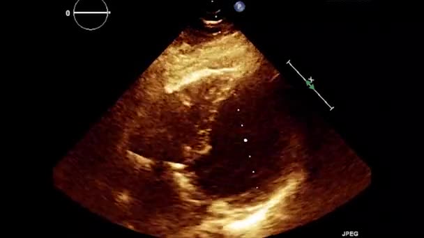 Video Transesophageální Ultrazvuk Srdce Transesofageální Ultrazvuková Echokardiografie — Stock video