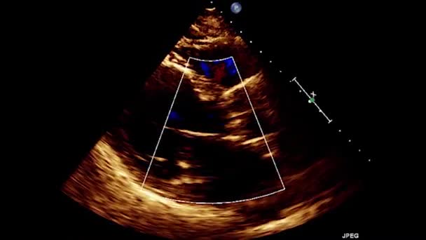 Kalbin Transsofageal Ultrasonu Transesophageal Ultrason Ekokardiyografisi — Stok video