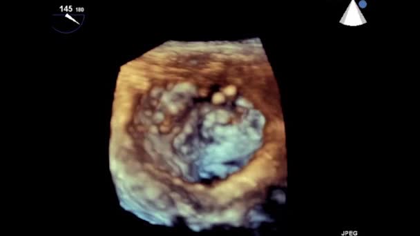 Video Transesofageale Echografie Van Het Hart Transslokdarmultrasone Echografie Echocardiografie — Stockvideo