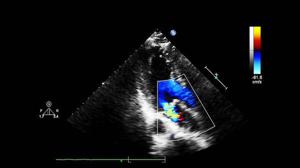 Экран эхокардиографической (ультразвуковой) машины
.