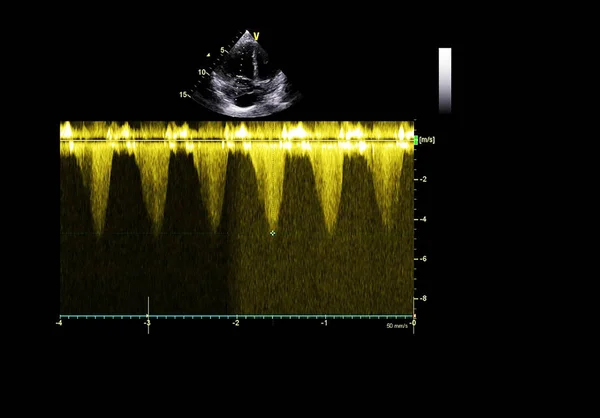 Tela da máquina de ecocardiografia (ultra-som) . — Fotografia de Stock