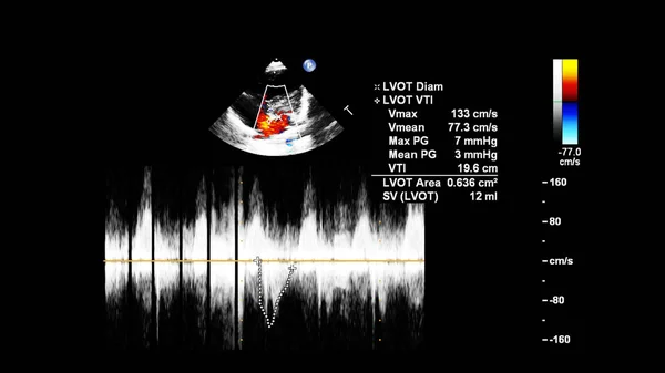 Screen of echocardiography (ultrasound) machine. — Stock Photo, Image