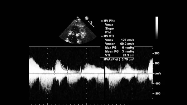 Tela da máquina de ecocardiografia (ultra-som) . — Fotografia de Stock