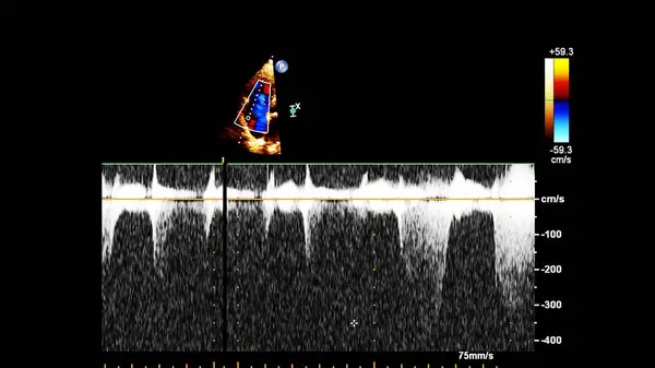 Pantalla de la máquina de ecocardiografía (ultrasonido) . —  Fotos de Stock