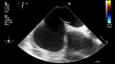 Kalbin transsofageal ultrason muayenesi.
