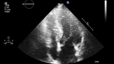 Kalbin transsofageal ultrason muayenesi.