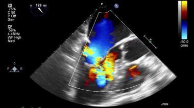 Kalbin transsofageal ultrason muayenesi.