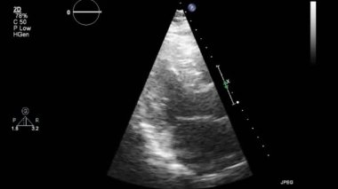 Kalbin transsofageal ultrason muayenesi.