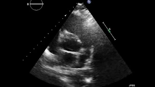 Exame Ultrassonográfico Transesofágico Coração — Vídeo de Stock