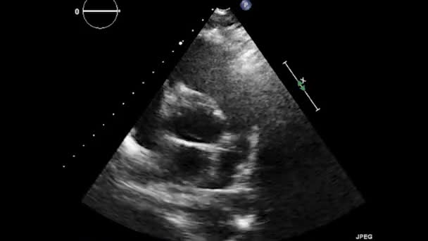 Transesofageální Ultrazvukové Vyšetření Srdce — Stock video