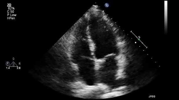 Exame Ultrassonográfico Transesofágico Coração — Vídeo de Stock