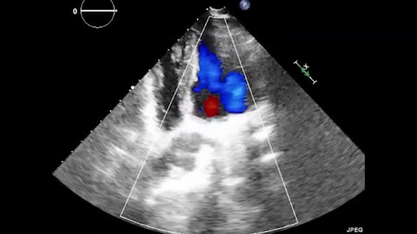 Badanie Ultrasonograficzne Przełyku Serca — Wideo stockowe