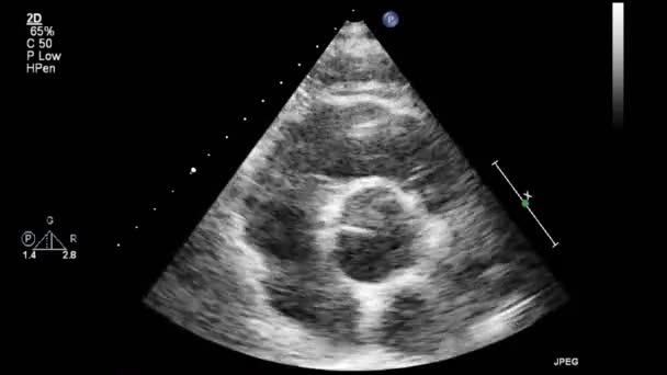 Transesophageal Ultrasound Examination Heart — Stock Video