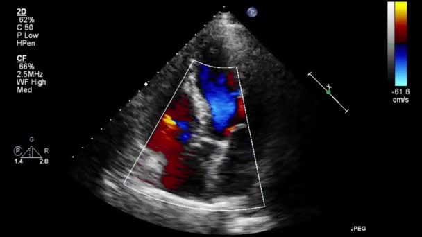 Transesofageální Ultrazvukové Vyšetření Srdce — Stock video