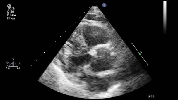 Transesophageale Ultraschalluntersuchung Des Herzens — Stockvideo