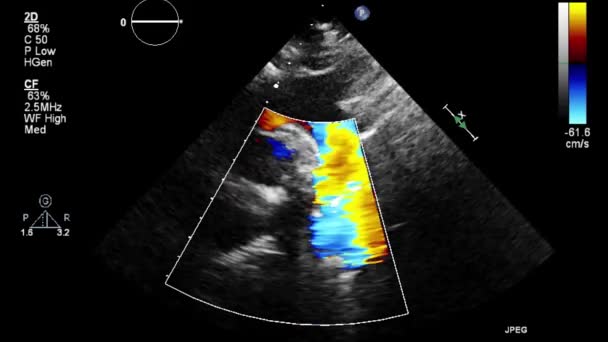 Transesophageal Ultrasound Examination Heart — Stock Video