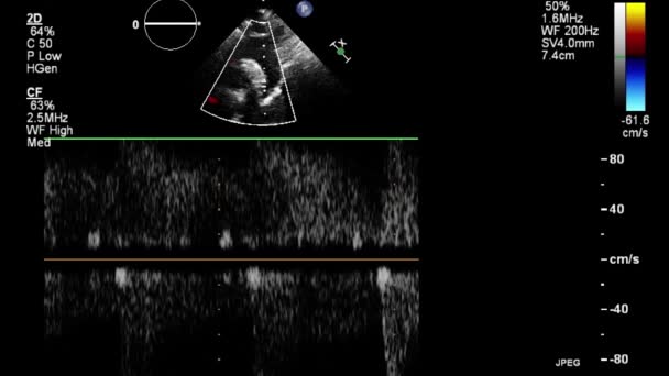 Kalbin Transsofageal Ultrason Muayenesi — Stok video